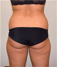 Liposuction Before Photo by David Rapaport, MD; New York, NY - Case 40442