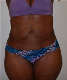 Liposuction After Photo by David Rapaport, MD; New York, NY - Case 40443