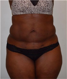 Liposuction Before Photo by David Rapaport, MD; New York, NY - Case 40443