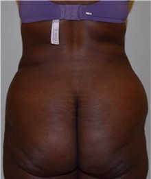 Liposuction After Photo by David Rapaport, MD; New York, NY - Case 40443