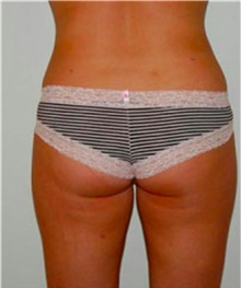 Liposuction After Photo by David Rapaport, MD; New York, NY - Case 40446