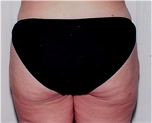Liposuction After Photo by David Rapaport, MD; New York, NY - Case 40447