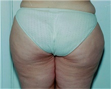 Liposuction Before Photo by David Rapaport, MD; New York, NY - Case 40447