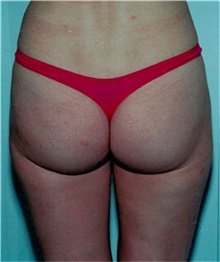 Liposuction After Photo by David Rapaport, MD; New York, NY - Case 40448