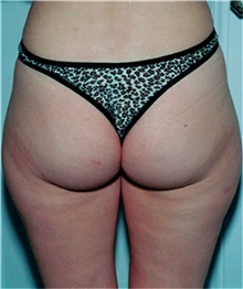 Liposuction Before Photo by David Rapaport, MD; New York, NY - Case 40448