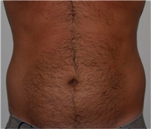 Liposuction Before Photo by David Rapaport, MD; New York, NY - Case 40450