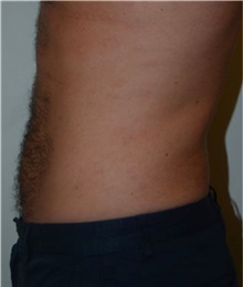 Liposuction After Photo by David Rapaport, MD; New York, NY - Case 40450