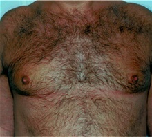 Liposuction After Photo by David Rapaport, MD; New York, NY - Case 40451