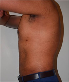 Liposuction After Photo by David Rapaport, MD; New York, NY - Case 40452