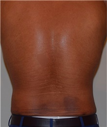 Liposuction After Photo by David Rapaport, MD; New York, NY - Case 40452