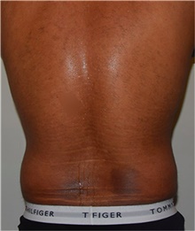 Liposuction Before Photo by David Rapaport, MD; New York, NY - Case 40452