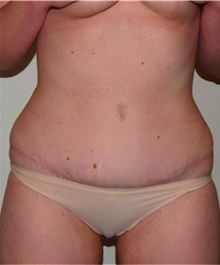 Tummy Tuck After Photo by David Rapaport, MD; New York, NY - Case 40455
