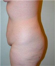 Tummy Tuck Before Photo by David Rapaport, MD; New York, NY - Case 40455