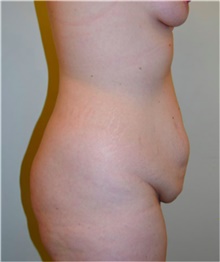 Tummy Tuck Before Photo by David Rapaport, MD; New York, NY - Case 40455