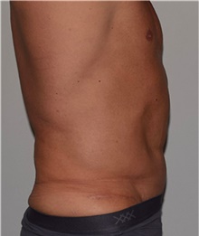 Tummy Tuck After Photo by David Rapaport, MD; New York, NY - Case 40456