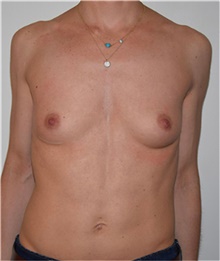 Breast Augmentation Before Photo by David Rapaport, MD; New York, NY - Case 40457