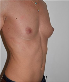 Breast Augmentation Before Photo by David Rapaport, MD; New York, NY - Case 40457