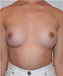 Breast Augmentation After Photo by David Rapaport, MD; New York, NY - Case 40458