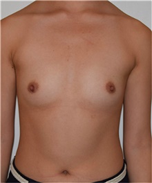 Breast Augmentation Before Photo by David Rapaport, MD; New York, NY - Case 40458