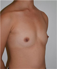 Breast Augmentation Before Photo by David Rapaport, MD; New York, NY - Case 40458