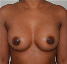 Breast Augmentation After Photo by David Rapaport, MD; New York, NY - Case 40459