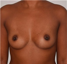 Breast Augmentation Before Photo by David Rapaport, MD; New York, NY - Case 40459