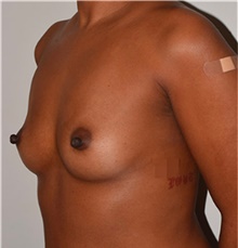 Breast Augmentation Before Photo by David Rapaport, MD; New York, NY - Case 40459