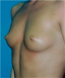 Breast Augmentation Before Photo by David Rapaport, MD; New York, NY - Case 40460