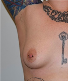 Breast Augmentation Before Photo by David Rapaport, MD; New York, NY - Case 40461