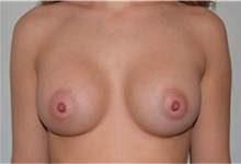 Breast Augmentation After Photo by David Rapaport, MD; New York, NY - Case 40462