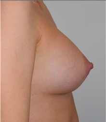 Breast Augmentation After Photo by David Rapaport, MD; New York, NY - Case 40462