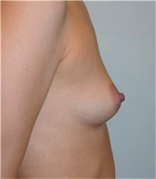 Breast Augmentation Before Photo by David Rapaport, MD; New York, NY - Case 40462