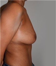 Breast Implant Removal After Photo by David Rapaport, MD; New York, NY - Case 40465