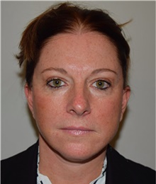 Facelift After Photo by David Rapaport, MD; New York, NY - Case 40466
