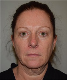 Facelift Before Photo by David Rapaport, MD; New York, NY - Case 40466