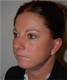 Facelift After Photo by David Rapaport, MD; New York, NY - Case 40466