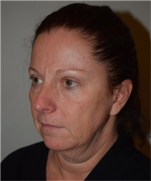 Facelift Before Photo by David Rapaport, MD; New York, NY - Case 40466