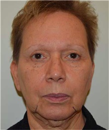 Facelift Before Photo by David Rapaport, MD; New York, NY - Case 40468