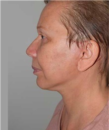 Facelift After Photo by David Rapaport, MD; New York, NY - Case 40468