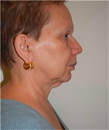 Facelift Before Photo by David Rapaport, MD; New York, NY - Case 40468