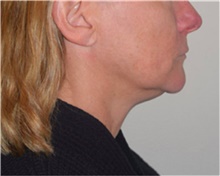 Facelift Before Photo by David Rapaport, MD; New York, NY - Case 40470