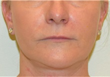 Facelift After Photo by David Rapaport, MD; New York, NY - Case 40470