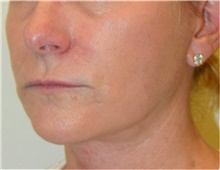 Facelift After Photo by David Rapaport, MD; New York, NY - Case 40470