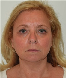 Facelift Before Photo by David Rapaport, MD; New York, NY - Case 40474