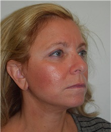 Facelift After Photo by David Rapaport, MD; New York, NY - Case 40474