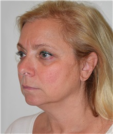 Facelift Before Photo by David Rapaport, MD; New York, NY - Case 40474