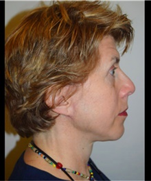 Facelift After Photo by David Rapaport, MD; New York, NY - Case 40476