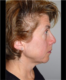 Facelift Before Photo by David Rapaport, MD; New York, NY - Case 40476