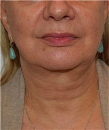 Facelift After Photo by David Rapaport, MD; New York, NY - Case 40477