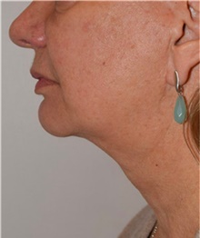Facelift After Photo by David Rapaport, MD; New York, NY - Case 40477